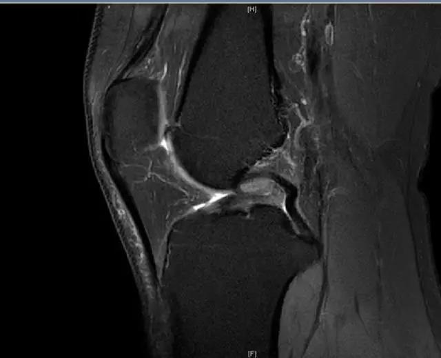 【有聲病例】前交叉韌帶斷裂，外側半月板后角撕裂