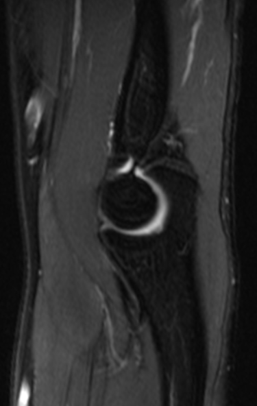 肘關節-fs T2