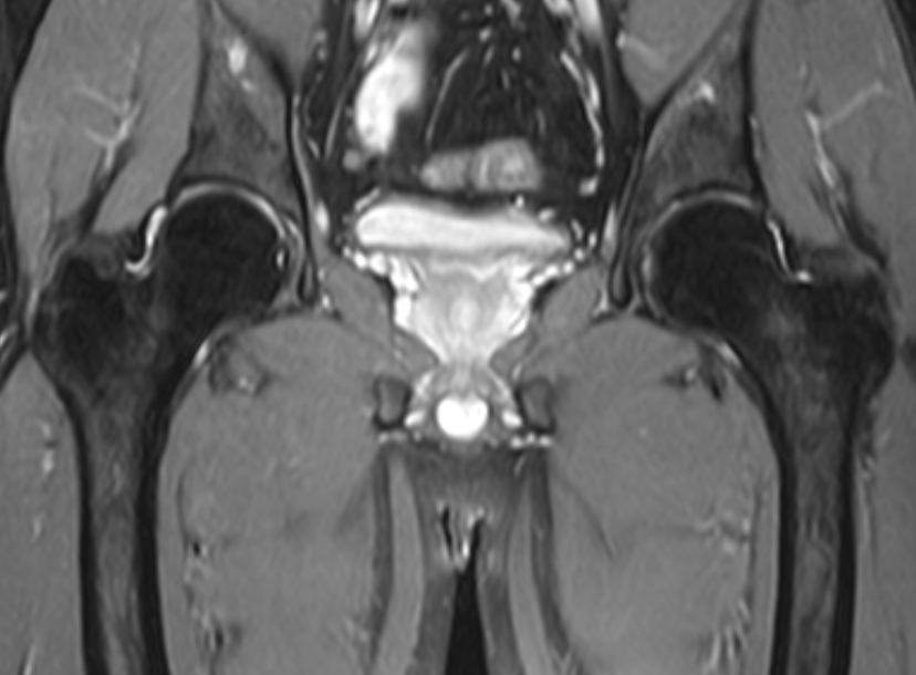 髖關節-fs T2