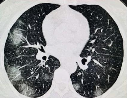 朗潤戰疫|新冠CT征象識別及特點