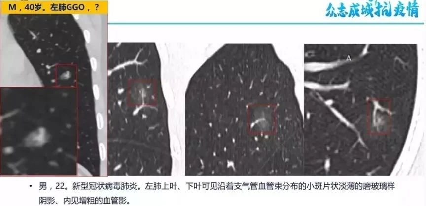 朗潤戰疫|CT影像學識別與診斷